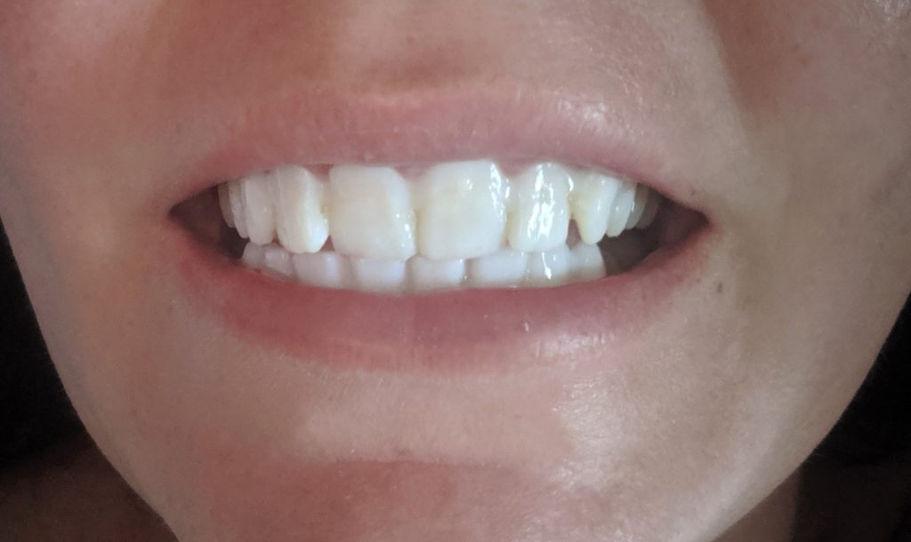 Temporary Teeth