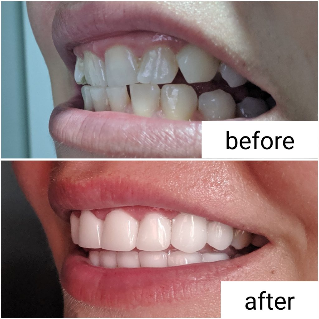 Before and After Veneers Dental Center Turkey
