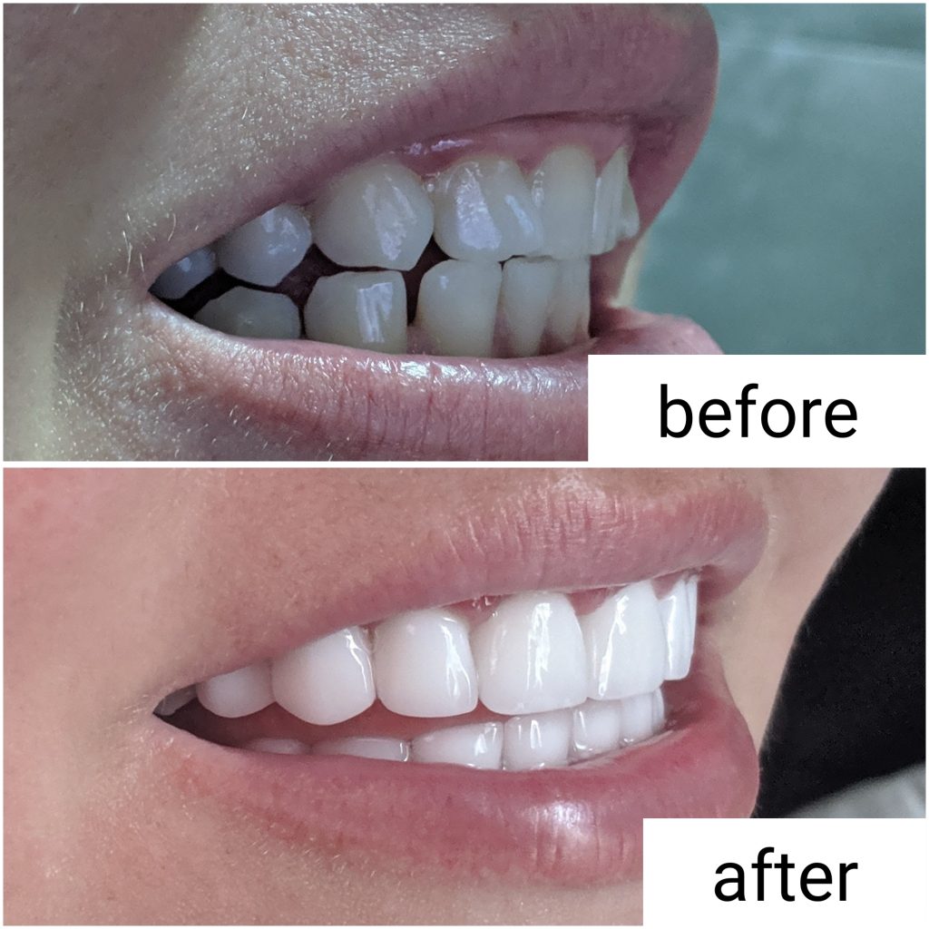 Before and After Veneers Dental Center Turkey